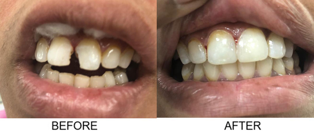 Dental Filling Front Teeth