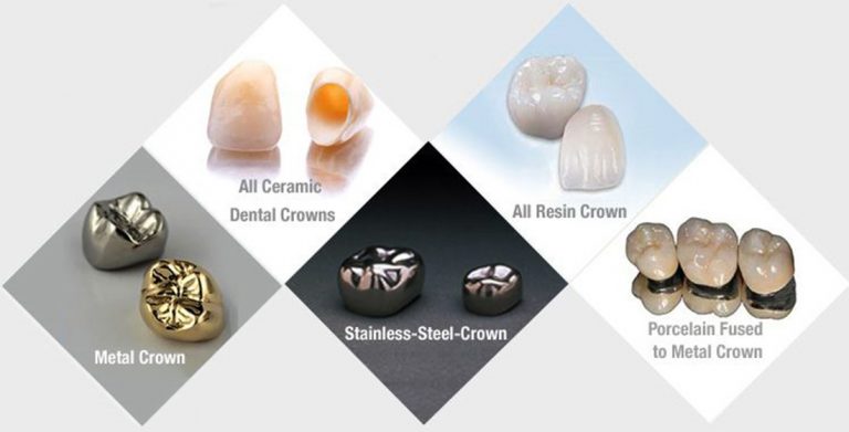 Dental Crowns and Caps in Hyderabad | Dental Crowns in Hyderabad