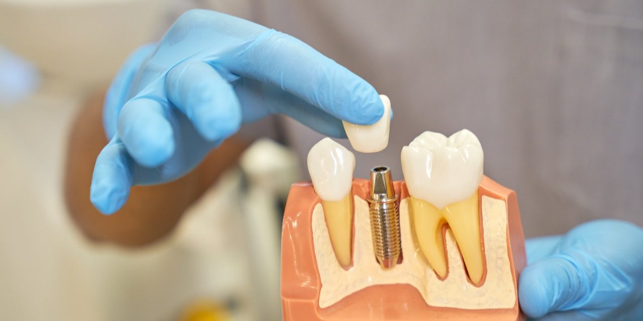 Types of Dental Implants and Oral Care Tips | Positive Dental