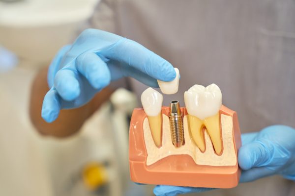 Types of Dental Implants Article Types of Dental Implants