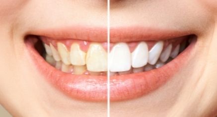 Dental Veeners _ Positive Dental