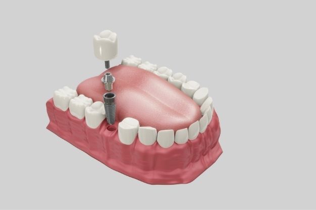 dental implants - Positive Dental