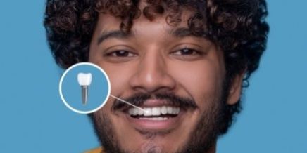 dental implants dental implants