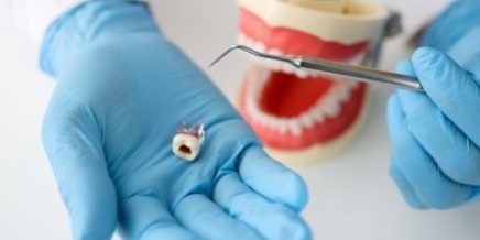root canal on crowned tooth –