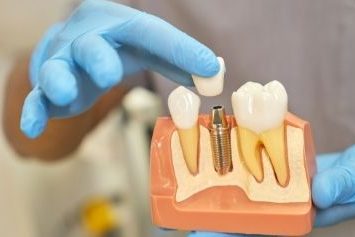 Dental Implants for Seniors -- Positive Dental