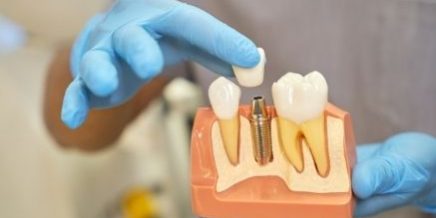 Dental Implants for Seniors -- Positive Dental