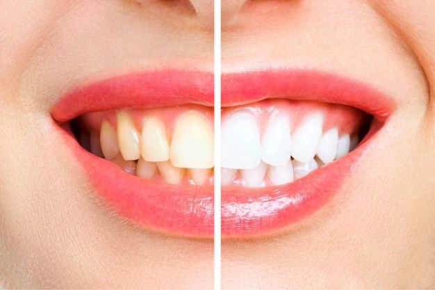 Laser Teeth Whitening - Positive Dental-