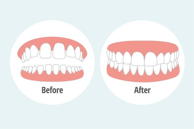Overbite Teeth Treatment - Positive Dental -