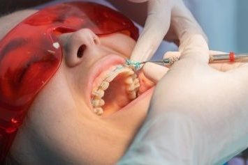 Overbite Teeth Treatment - Positive Dental