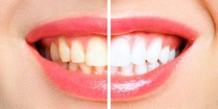 Tooth whitening and celebrities interlinked - Positive Dental