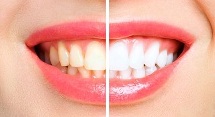 How are Teeth whitening and celebrities interlinked?